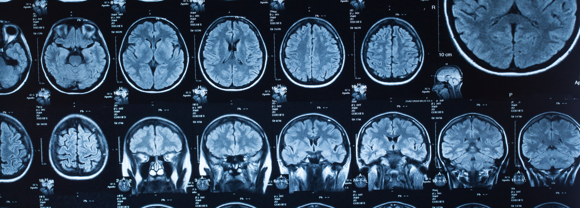 Brain CT Scans