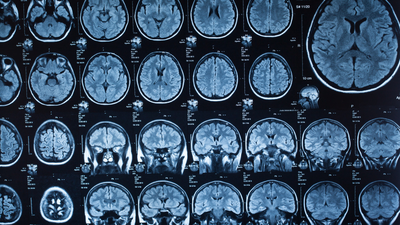 Brain CT Scans